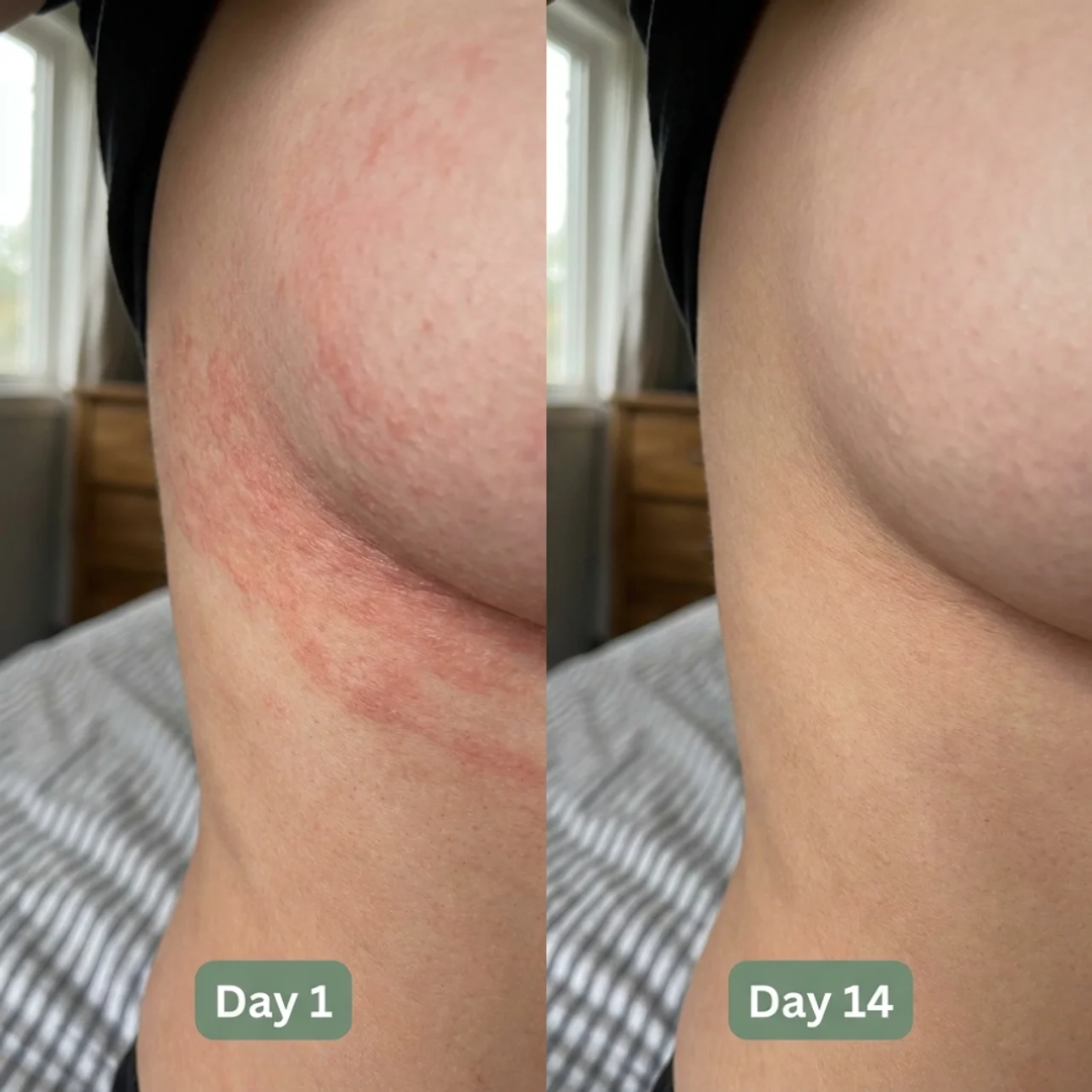 Darco™ Rash Break Formula